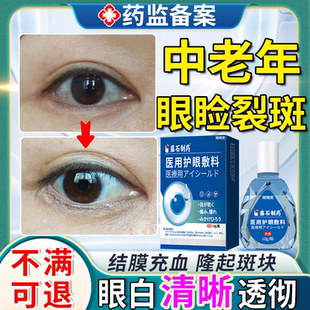 眼睑裂斑中可搭眼药水去红血丝抗疲劳黄斑病变眼白发黄清澈去黄EM