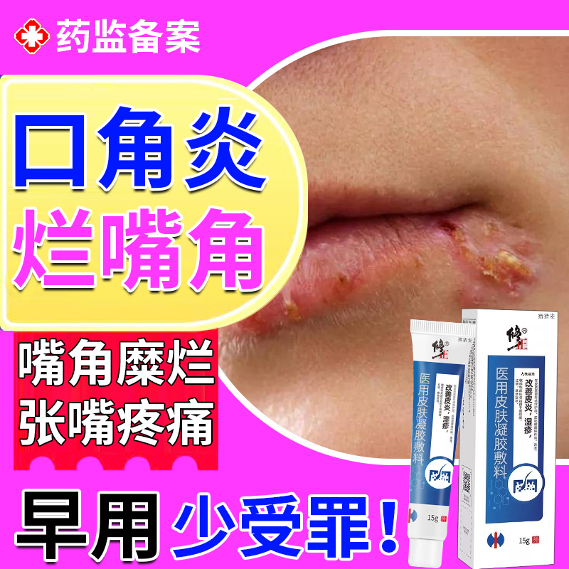 【口角炎烂嘴角嘴疼】现货速发