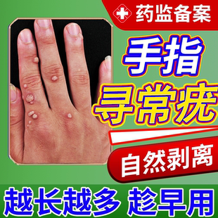 手上长硬疙瘩寻常疣膏去除甲周疣根刺猴瘊子神器祛疣除疣专用贴JW