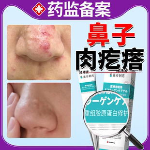 鼻子上肉疙瘩去除鼻部血管鼻头皮脂腺增生凸起的痘痘疤痕长肉粒OZ