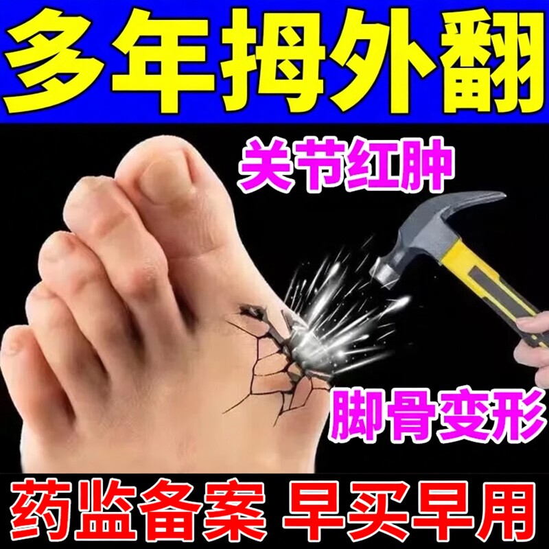 拇指外翻拇外翻药膏贴女士大脚骨矫正器拇囊炎大脚母疼痛膏药贴DZ