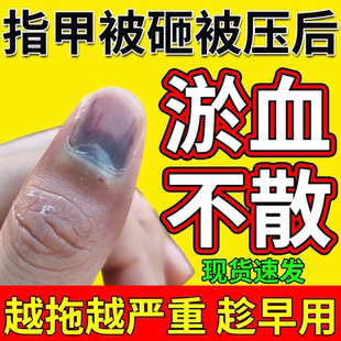 手脚趾指甲被夹被砸压甲床受损受伤甲下淤血发紫淤青发黑生长液JW