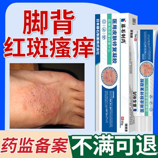 脚背湿疹瘙痒脚上水泡止痒去真菌感染根脚癣脚面痒的药房同款膏EM