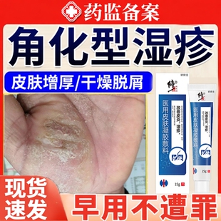 角化型手部湿疹皮肤真菌感染去止痒根手癣膏脱皮干裂角质化皲裂JW