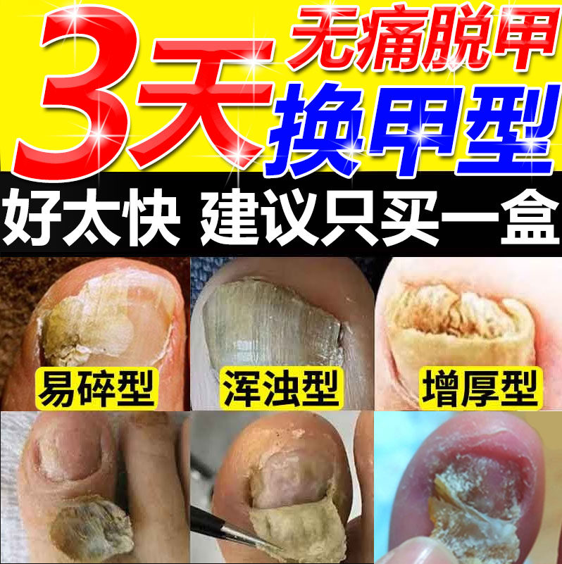 灰指甲沟炎专用膏药贴指甲刀正品根修脚剪指刀打磨器冰醋酸涂剂JW