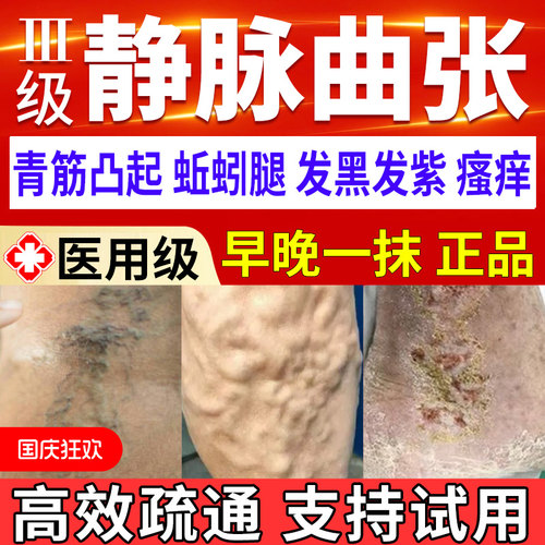 静脉曲张特效专用冷敷药膏凝胶膏药一名第官方旗舰店特专效用膏贴