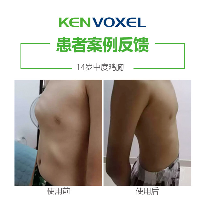 定制鸡胸支具胸骨鸡胸矫正器儿童鸡胸矫正器成人医院同款