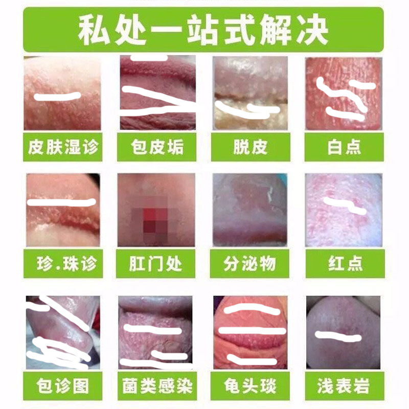 龟头红点异味白垢白点男用清洗男士私处护理抑菌喷剂包皮龟炎头