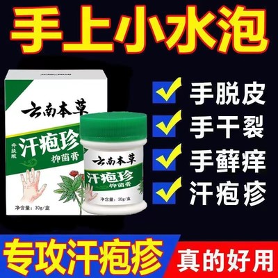 汗泡疱珍疹药膏止痒手上起小水泡