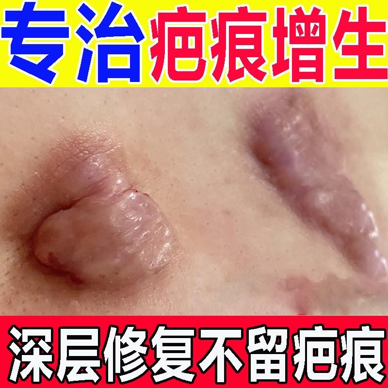 疤痕增生凸起去除疙瘩祛伤剖腹产烧烫伤疤修复膏刀疤贴痒手术缝针