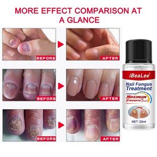 7 DAYS Nail Fungus Treatment Essence Feet Care Anti Infectio
