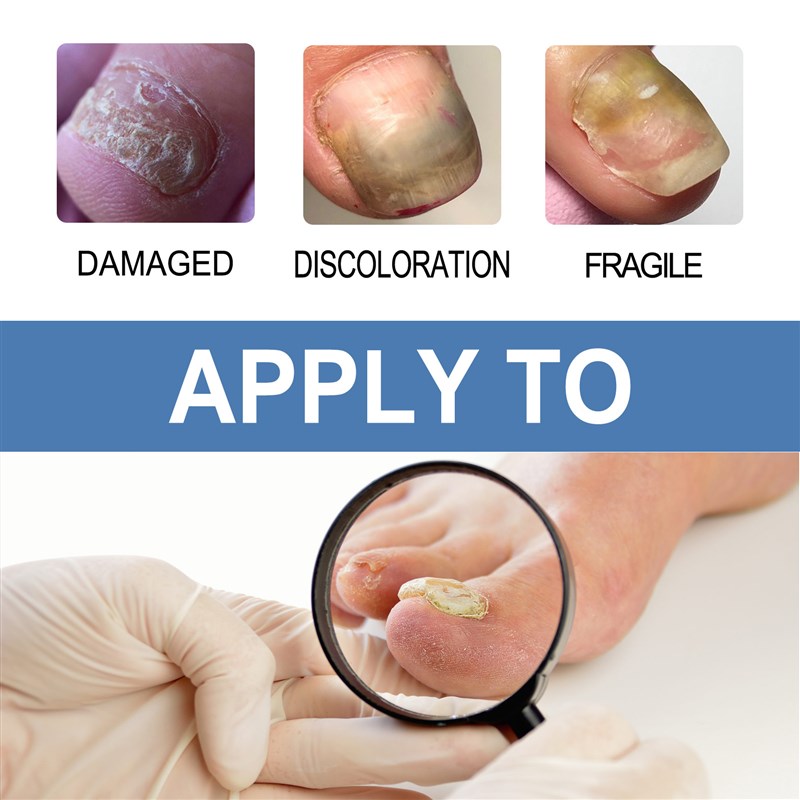 Repair Paronychia Fungus Gel Anti Infection Cure Hand Foot T