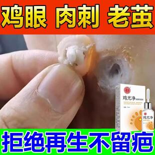 鸡眼膏贴脚鸡贴眼跖疣去除膏寻常疣去脖子上长小肉粒尤瘊药水神器