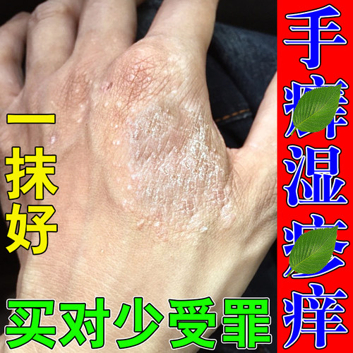 手指关节鲜真菌指手指关节干裂痒指节膏指关节手指关节鲜膏