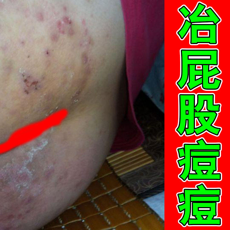 屁股上长痘痘痒起热疙瘩痱子久坐皮肤消毒护理（消）