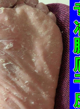 脚底严重起皮脚心痒脚底起皮真菌干裂起硬皮足跟开裂专用修护喷剂