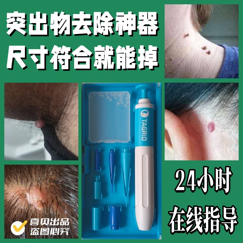 皮赘疙瘩肉瘤猴子去除神器勒脖子腋下小肉球物理祛除工具胶圈皮筋