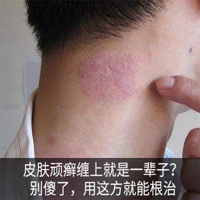 脖子红痒股沟癣亿柠康消氏化痔膏达膏克灵软膏林柠丹