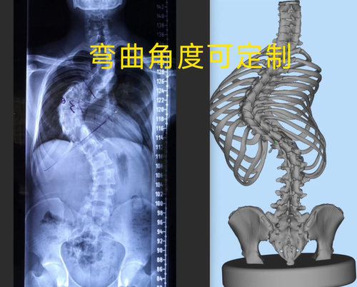 定制3D打印脊柱侧弯筛查模型S弯C弯300mm桌面摆件骨架角度可定制