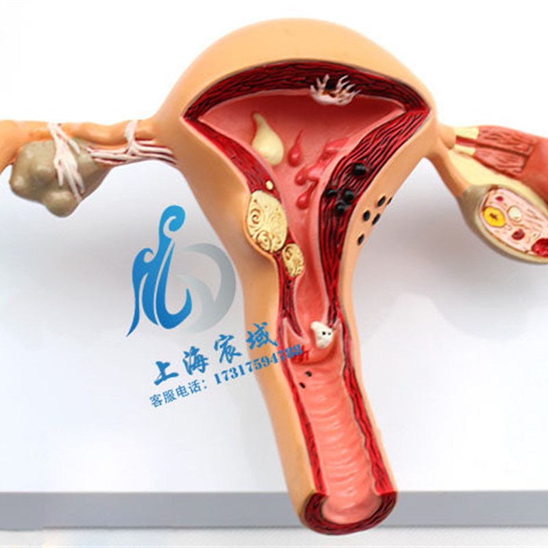 子宫卵巢病理病变模型 生殖A科 女性内外生殖器官模具教学病变