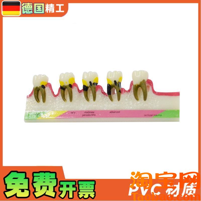 原装适用德国】PNT-OR13树脂成人牙周病变牙齿模型口腔牙科教学摆