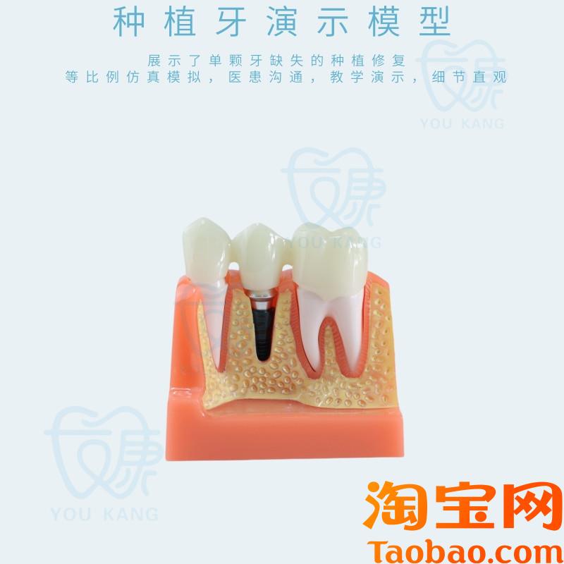 原装适用牙科种植牙模型模拟仿真口腔教学模型种植牙可拆卸牙齿厂