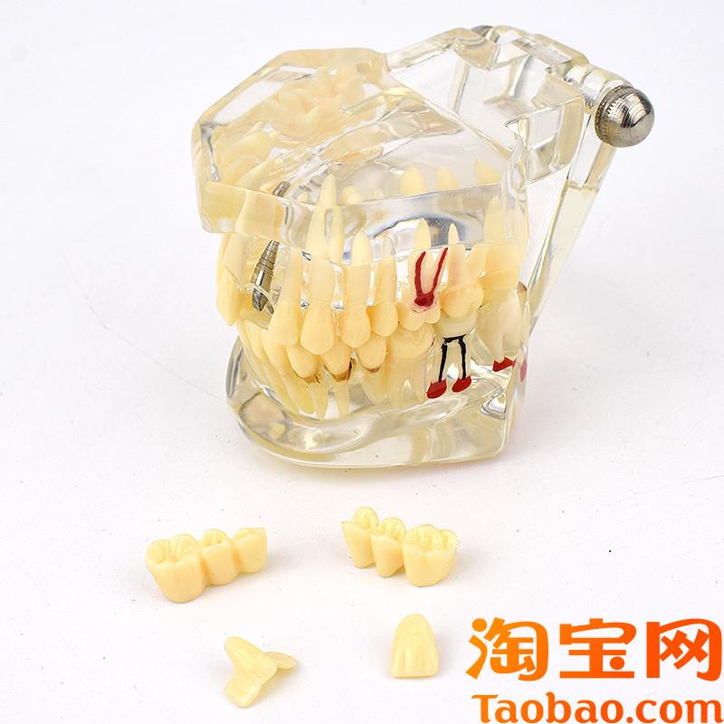 原装适用ENOVO颐诺口腔模型齿科种植阻生齿牙体牙髓口腔教学马里
