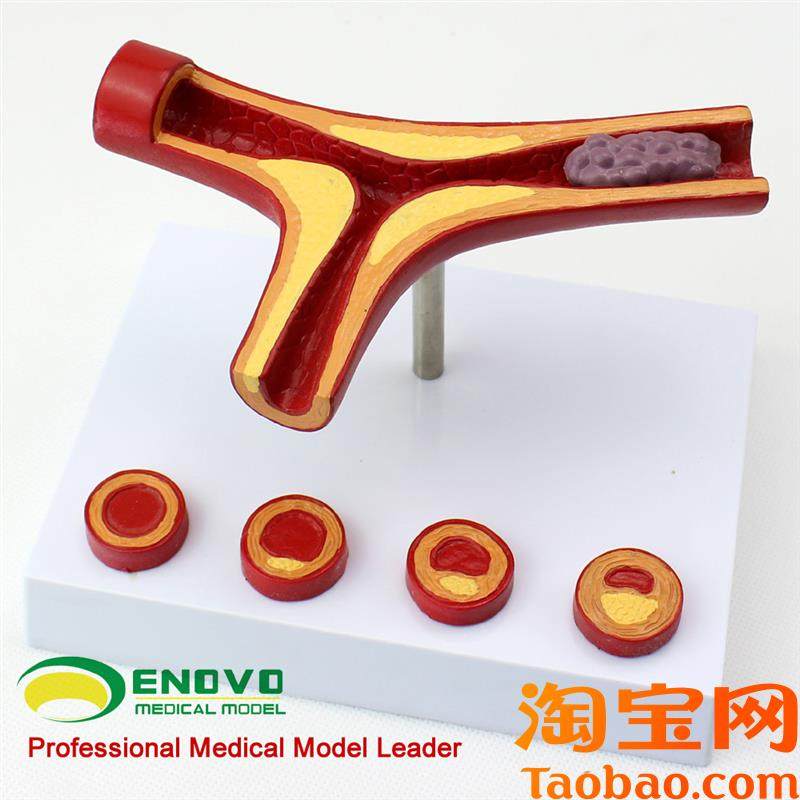 颐诺正品冠状动脉性心血管动脉硬化模型老年心脏模.型血栓形成