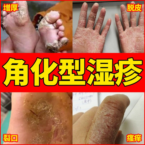 鹅掌风专用手癣膏药脱皮干裂真菌感染角化型湿疹手部角化皲裂性