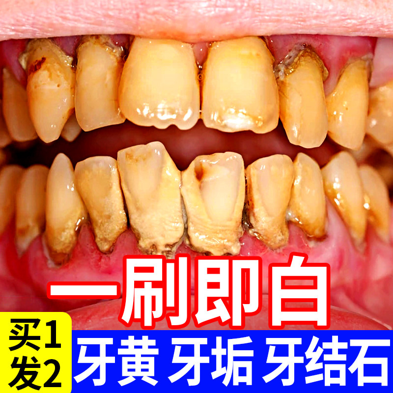 Xinmior洗牙洁牙粉去黄洗白变美白牙齿非速傚亮白神器去牙渍牙黄