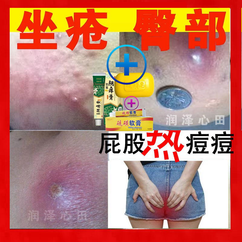 屁股长豆了座板仓疮膏屁股上解毒久长热豆疖子浓包水