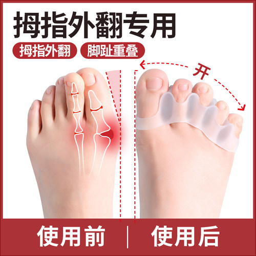 脚趾矫正器拇指外翻纠正脚趾神器