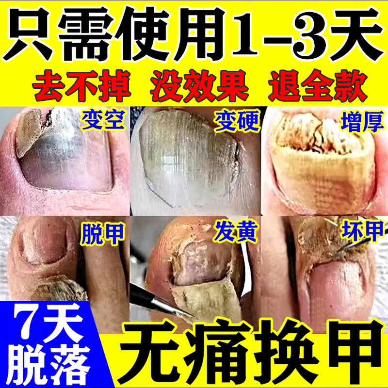 灰指甲药水特效专用凤仙花抑菌液医用用具