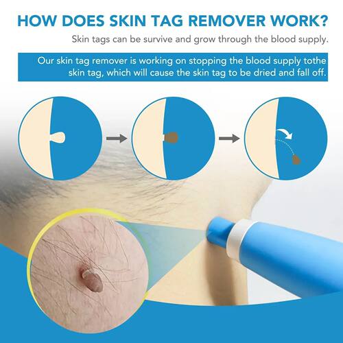 Wart Remover Kit for Flat Plantar Warts & Moles with Liquid