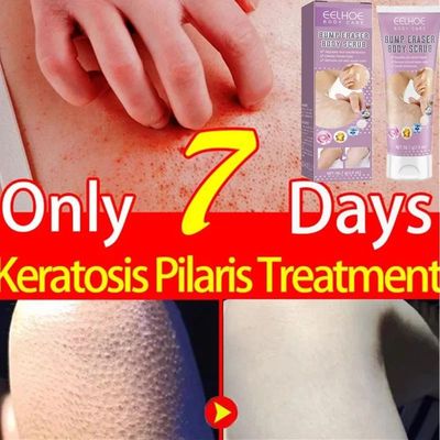 Moisturizing Body Scrub Repairing Keratin Hyperplasia Removi