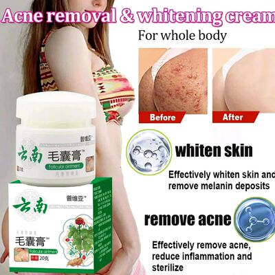 Body Acne Removal Cream atment Face Butt Back Acne Marks Smo
