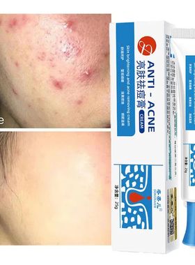 Salicylic Acid Acne Removal Cream Anti-Acne Repair Redness P