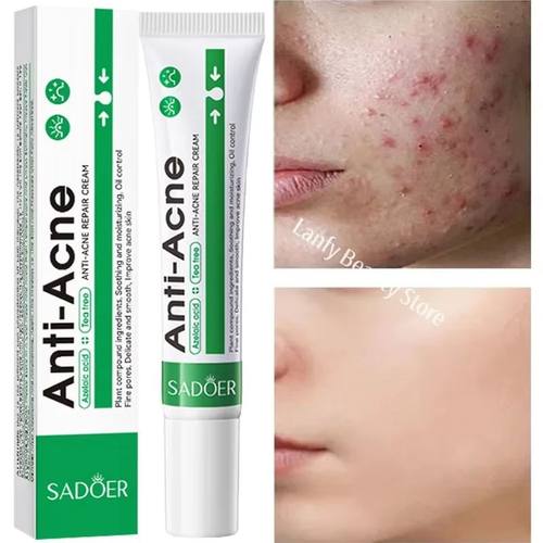 Salicylic Acid Acne atment Face Cream Repair Pimple Spots De