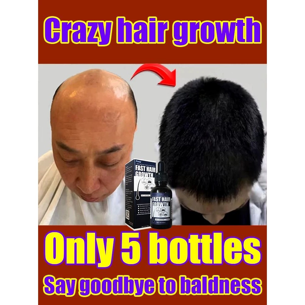【Venda quente】 Essência de crescimento capilar milagroso,