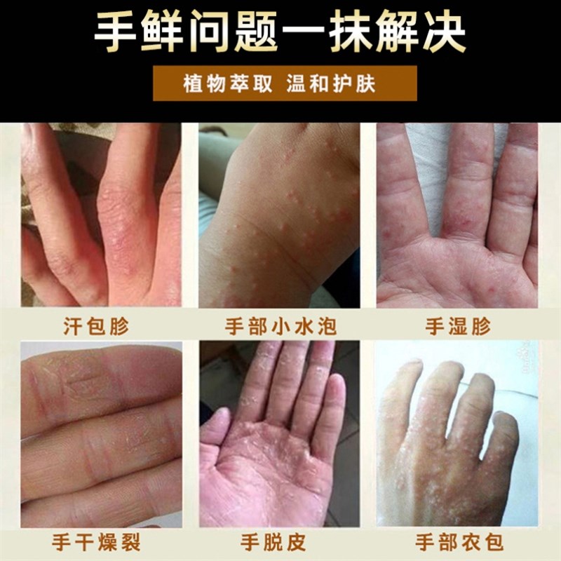 手起水泡痒手气染真菌感膏皮掌风干裂脱鹅l手癣膏手足藓脚藓真菌