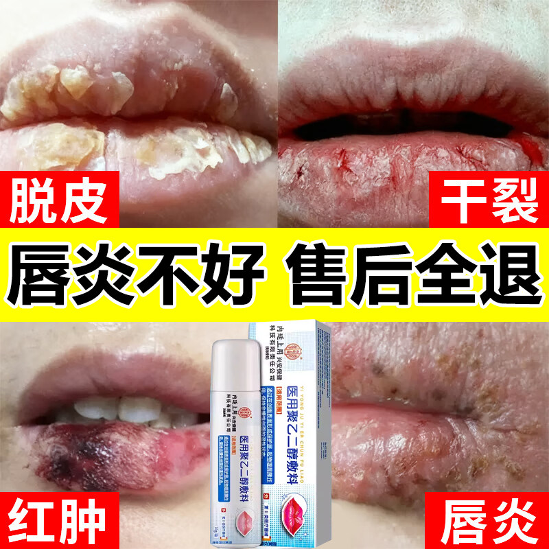 唇炎润唇膏嘴唇干裂脱皮专用保湿滋润去死皮口角炎疱疹医用修护膏,医疗器械,医用乳膏（器械）,淘宝优惠券,粉丝福利购,淘宝优惠卷