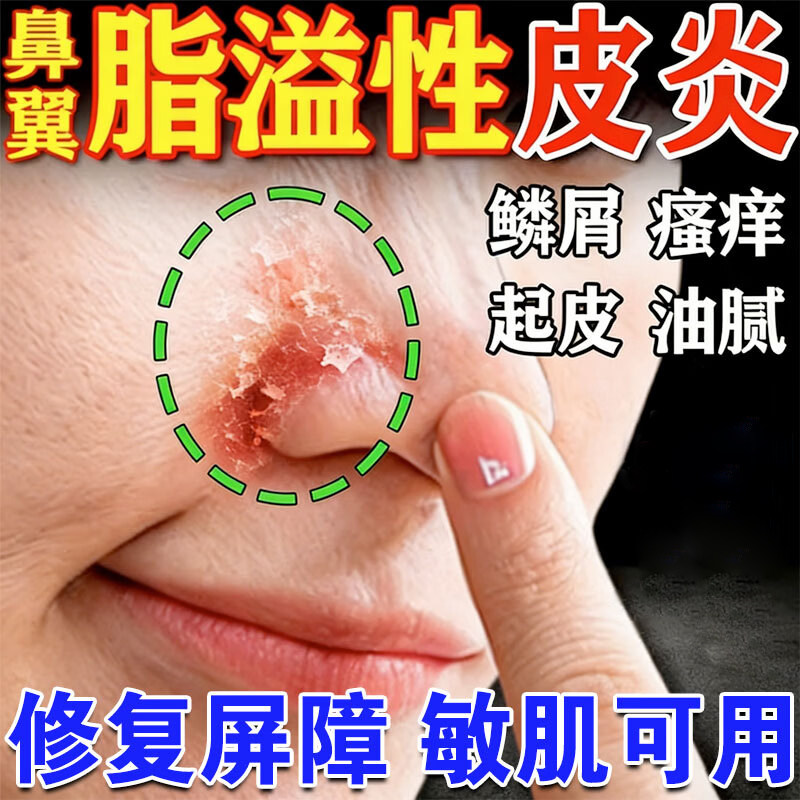 鼻翼两侧发红修复鼻子脱皮爱起皮红血丝瘙痒脂溢性皮炎凝胶修复