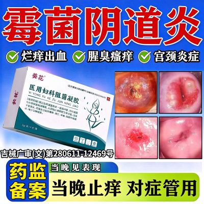 霉菌性阴道炎效特专用膏药治反复妇科白带多豆腐渣私密处瘙痒凝胶