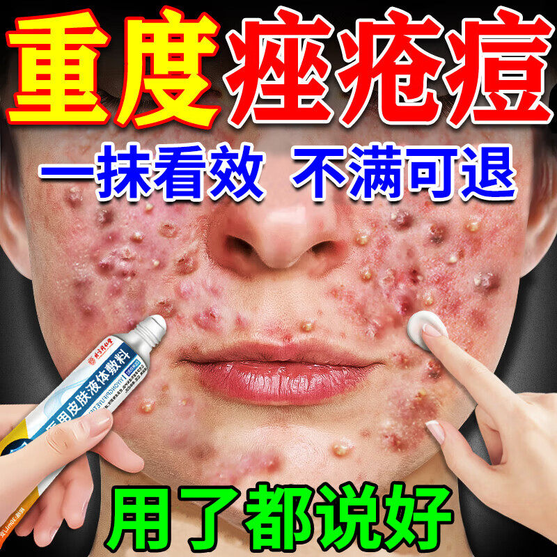 痤疮专用膏玫瑰痤疮粉刺硬消炎青少年保湿补水淡斑学生祛痘印膏药