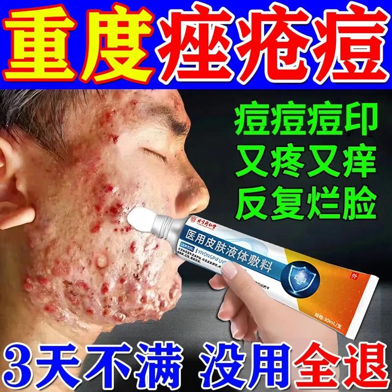 痤疮专用膏玫瑰痤疮粉刺硬消炎青少年保湿补水淡斑学生祛痘印膏药