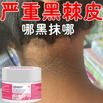 黑棘皮症去除脖子黑色素沉淀淡化黑棘皮洗不干净去黑脖子变白神器