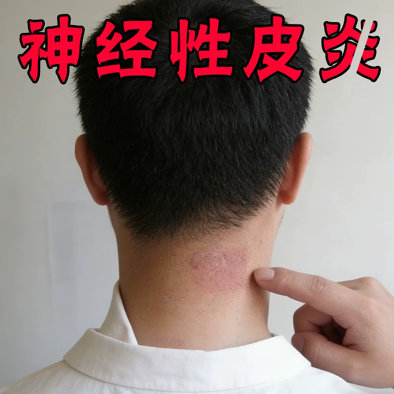 治疗神经性皮炎根去除外用膏顽固皮肤病皮癣藓湿疹真菌感染药膏