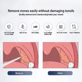 Electric Tonsil Stone Remover Tonsil Stone Removal Kit