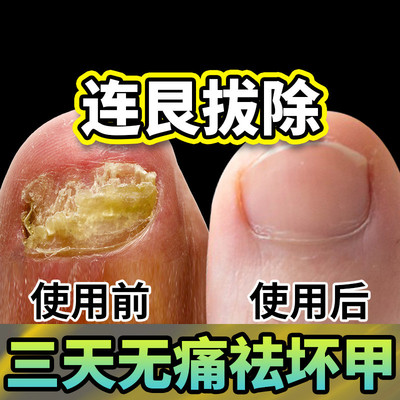 脱甲金油灰指甲液脱甲膏药去除增厚抑菌脚趾无痛去除软甲膏增厚角