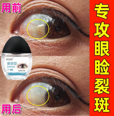 眼睑裂斑眼药水眼白发黄眼睛清澈去黄红血丝去异物感模糊浑浊结膜